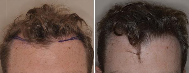 Hair Transplant Before and After Photos in Miami, FL, Patient 2679