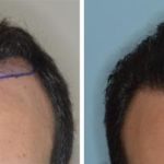 Hair Transplant Before and After Photos in Miami, FL, Patient 2738