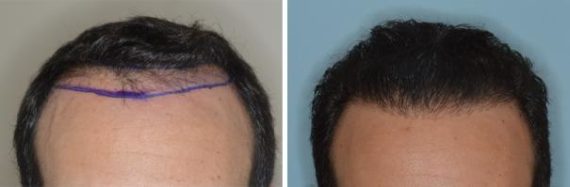 Hair Transplant Before and After Photos in Miami, FL, Patient 2738