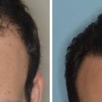 Hair Transplant Before and After Photos in Miami, FL, Patient 2738