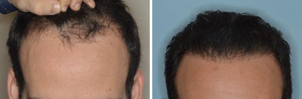 Hair Transplant Before and After Photos in Miami, FL, Patient 2738