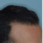 Hair Transplant Before and After Photos in Miami, FL, Patient 2738