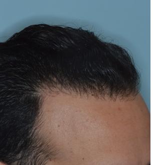 Hair Transplant Before and After Photos in Miami, FL, Patient 2738