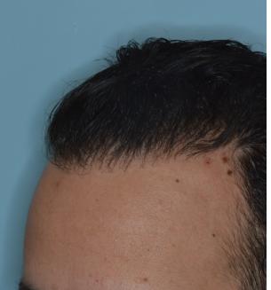 Hair Transplant Before and After Photos in Miami, FL, Patient 2738