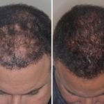 Hair Transplant Before and After Photos in Miami, FL, Patient 2743