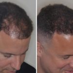 Hair Transplant Before and After Photos in Miami, FL, Patient 2743