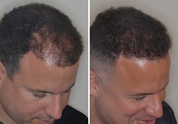 Hair Transplant Before and After Photos in Miami, FL, Patient 2743