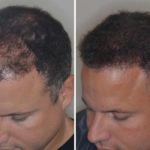 Hair Transplant Before and After Photos in Miami, FL, Patient 2743