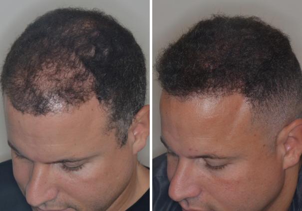 Hair Transplant Before and After Photos in Miami, FL, Patient 2743