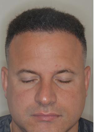 Hair Transplant Before and After Photos in Miami, FL, Patient 2743