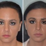 Hair Transplant Before and After Photos in Miami, FL, Patient 2748