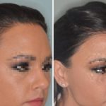 Hair Transplant Before and After Photos in Miami, FL, Patient 2748