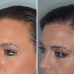 Hair Transplant Before and After Photos in Miami, FL, Patient 2748