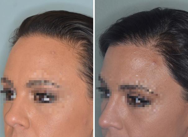 Hair Transplant Before and After Photos in Miami, FL, Patient 2748