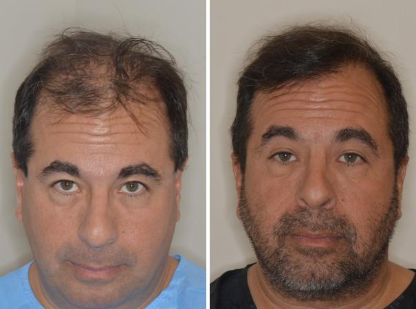 Hair Transplant Before and After Photos in Miami, FL, Patient 2752