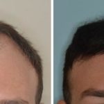 Hair Transplant Before and After Photos in Miami, FL, Patient 2754