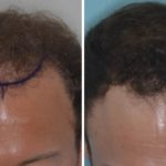 Hair Transplant Before and After Photos in Miami, FL, Patient 2763