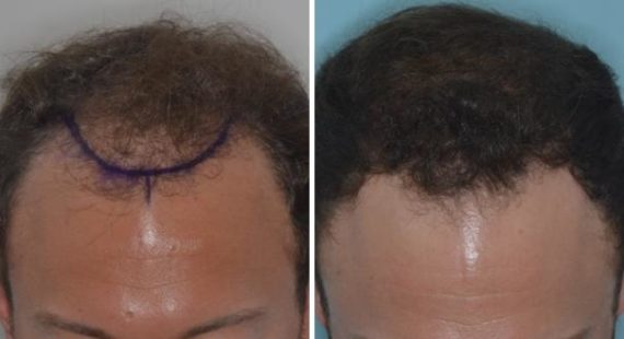 Hair Transplant Before and After Photos in Miami, FL, Patient 2763