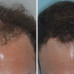 Hair Transplant Before and After Photos in Miami, FL, Patient 2763