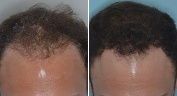 Hair Transplant Before and After Photos in Miami, FL, Patient 2763