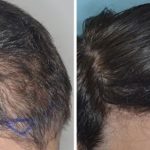 Hair Transplant Before and After Photos in Miami, FL, Patient 2766