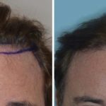 Hair Transplant Before and After Photos in Miami, FL, Patient 2773