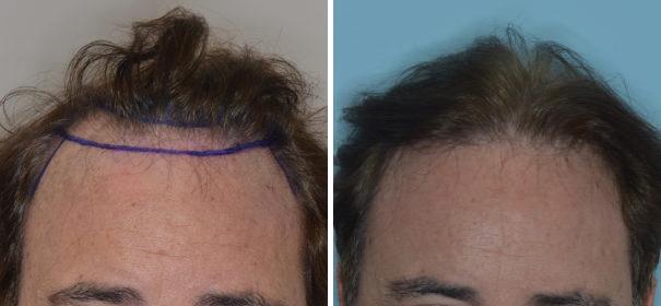 Hair Transplant Before and After Photos in Miami, FL, Patient 2773