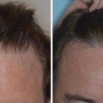 Hair Transplant Before and After Photos in Miami, FL, Patient 2773