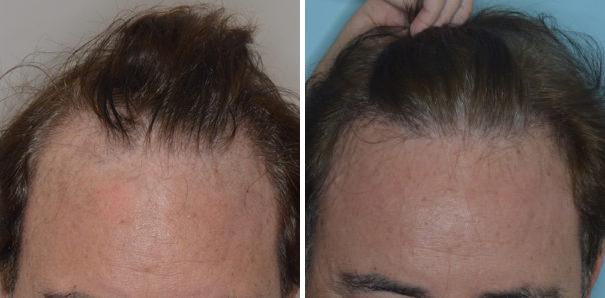 Hair Transplant Before and After Photos in Miami, FL, Patient 2773