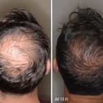 Hair Transplant Before and After Photos in Miami, FL, Patient 2688