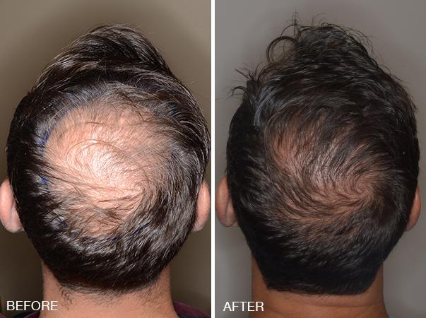 Hair Transplant Before and After Photos in Miami, FL, Patient 2688