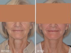 Laser Resurfacing Before and After Photos in Miami, FL, Patient 2612