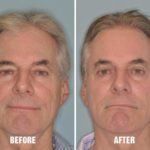 Laser Resurfacing Before and After Photos in Miami, FL, Patient 2632