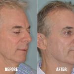 Laser Resurfacing Before and After Photos in Miami, FL, Patient 2632