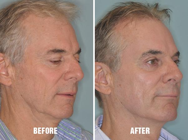 Laser Resurfacing Before and After Photos in Miami, FL, Patient 2632