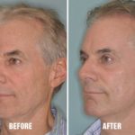 Laser Resurfacing Before and After Photos in Miami, FL, Patient 2632