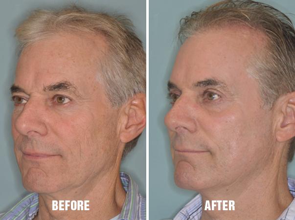 Laser Resurfacing Before and After Photos in Miami, FL, Patient 2632