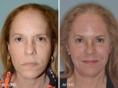 Laser Resurfacing Before and After Photos in Miami, FL, Patient 2564