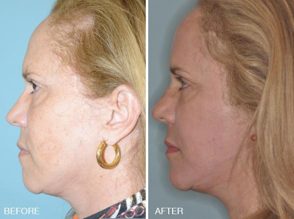 Laser Resurfacing Before and After Photos in Miami, FL, Patient 2564