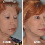 Necklift Before and After Photos in Miami, FL, Patient 2534