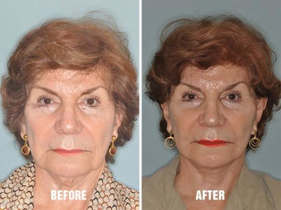 Necklift Before and After Photos in Miami, FL, Patient 2782