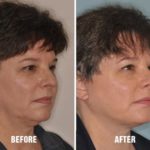 Necklift Before and After Photos in Miami, FL, Patient 2786