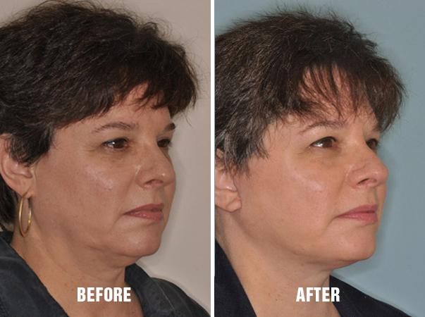 Necklift Before and After Photos in Miami, FL, Patient 2786