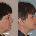 Necklift Before and After Photos in Miami, FL, Patient 2786