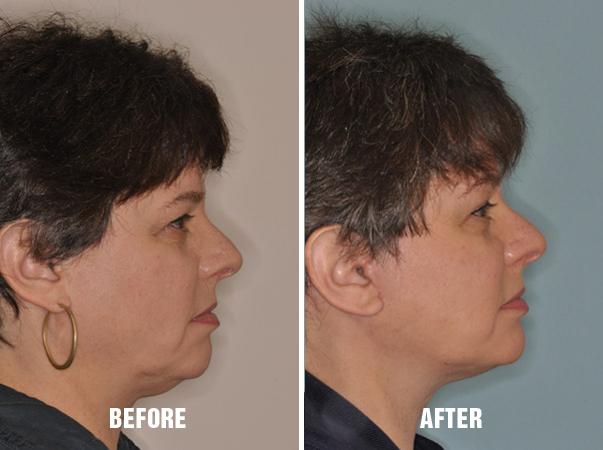 Necklift Before and After Photos in Miami, FL, Patient 2786