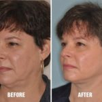 Necklift Before and After Photos in Miami, FL, Patient 2786