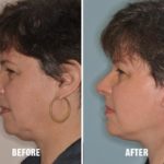 Necklift Before and After Photos in Miami, FL, Patient 2786