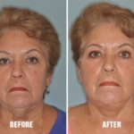 Necklift Before and After Photos in Miami, FL, Patient 2792