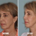 Necklift Before and After Photos in Miami, FL, Patient 2795