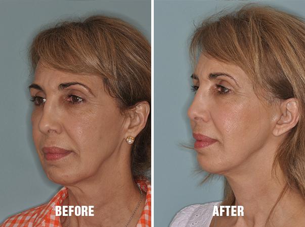 Necklift Before and After Photos in Miami, FL, Patient 2795